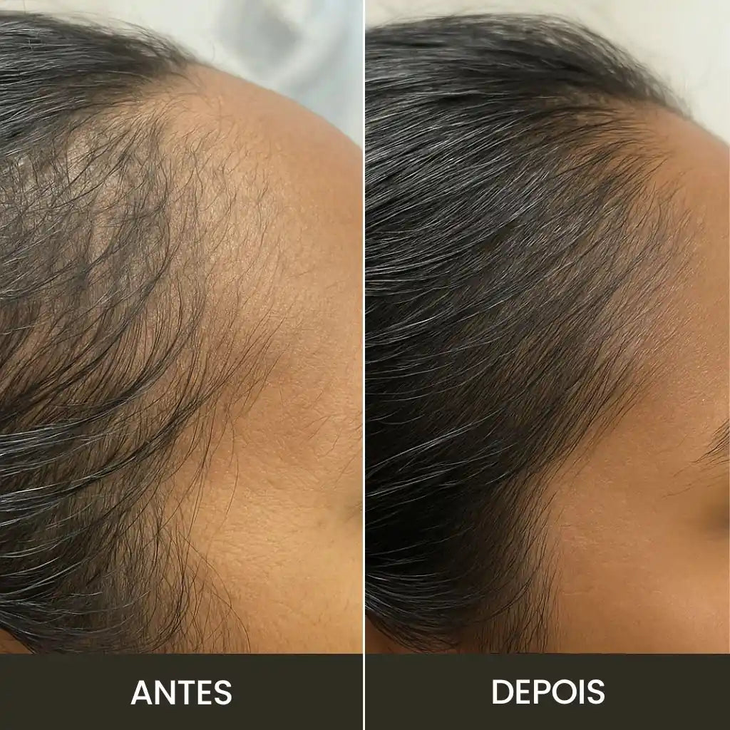 Kit Anti-Queda | Escova Therabrush & Óleo de Alecrim