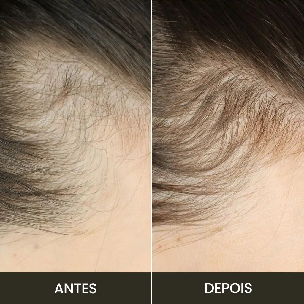 Kit Anti-Queda | Escova Therabrush & Óleo de Alecrim