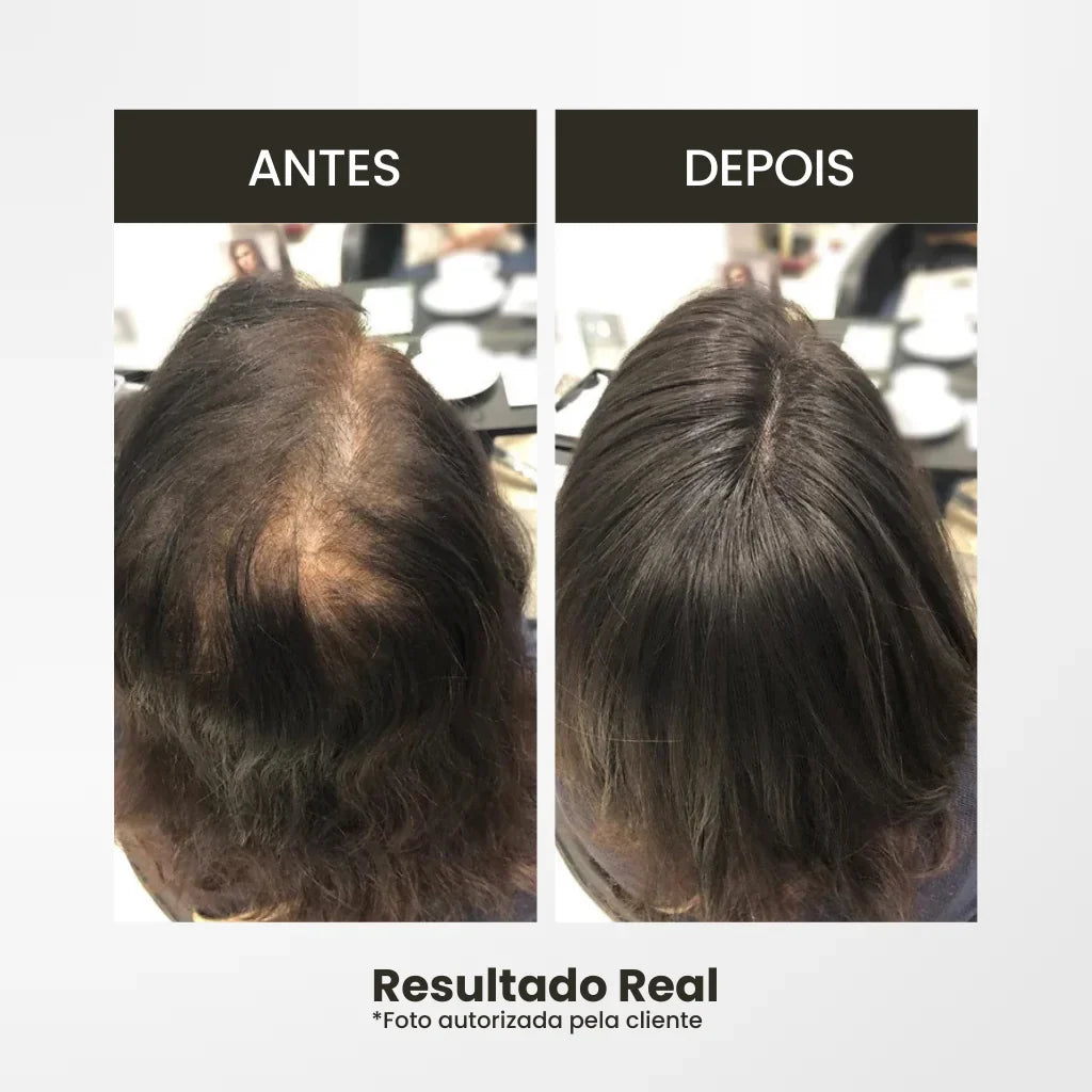 Top Closure - Topo de Cabelo Natural com Franja 45cm | Para Alopecia e Falhas