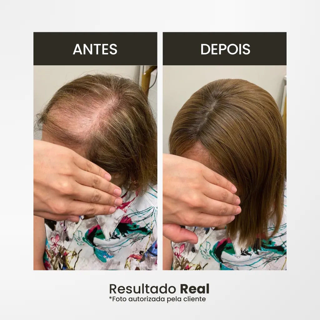 Top Closure - Topo de Cabelo Natural com Franja 45cm | Para Alopecia e Falhas