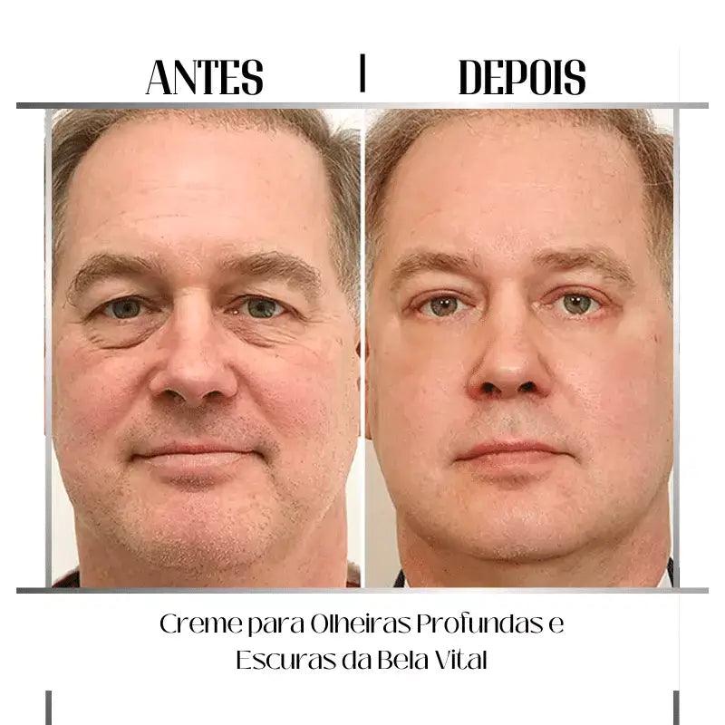 Creme para Olheiras Profundas e Escuras